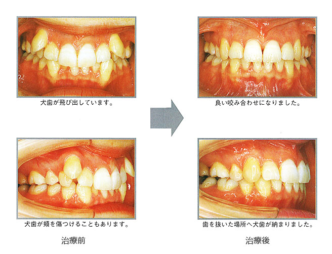 子どもの矯正 歯並びの種類 神戸矯正歯科グループ