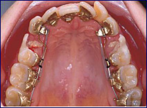 歯の裏側に装置をつける部分矯正