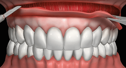 くちびると歯の間の粘膜の部分を切除
