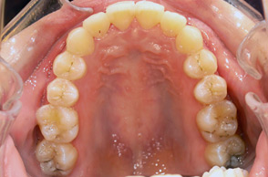 出っ歯（口ゴボ）の治療例2-4