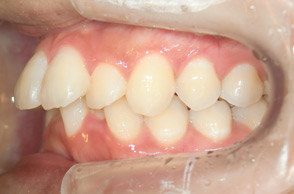 出っ歯（口ゴボ）の治療例2-1