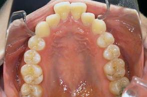 出っ歯（口ゴボ）の治療例2-3