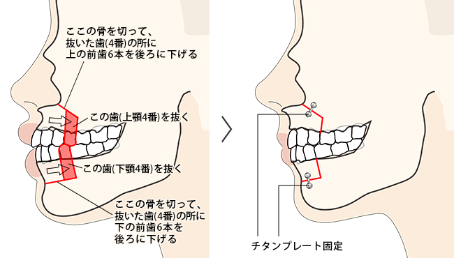 上下セットバック