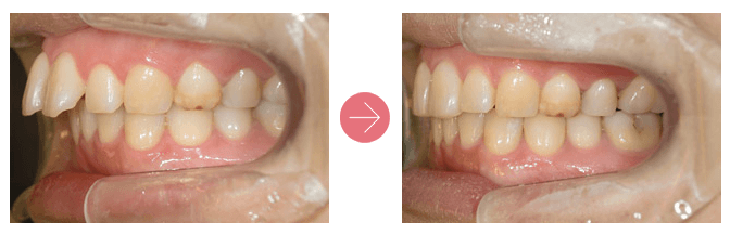 出っ歯 口ゴボ でお悩みの方 矯正でも手術でもキレイに治ります