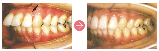 出っ歯 口ゴボ でお悩みの方 矯正でも手術でもキレイに治ります