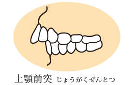 悪い歯並びの代表例 神戸矯正歯科グループ